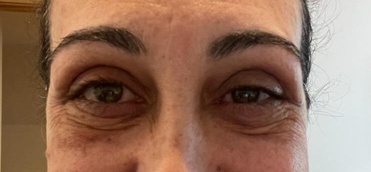 blefaroplastia y tic en parpado - 59996