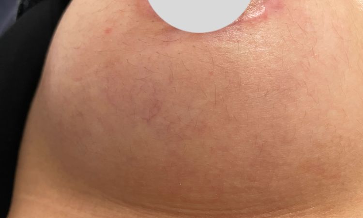 Aparición de vello tras aumento mamario - 60092