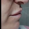 Restyline Volyme para aumento de labios
