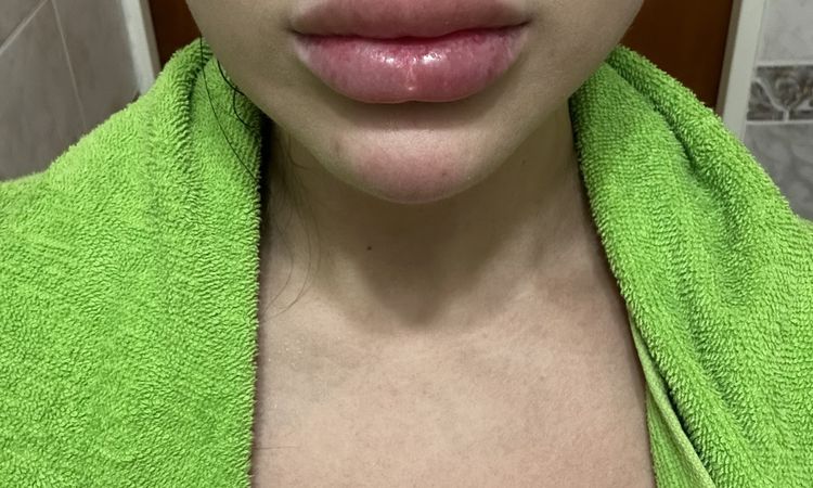 Endopeel en el rostro por primera vez, no iba a inflamarse mucho - 60167