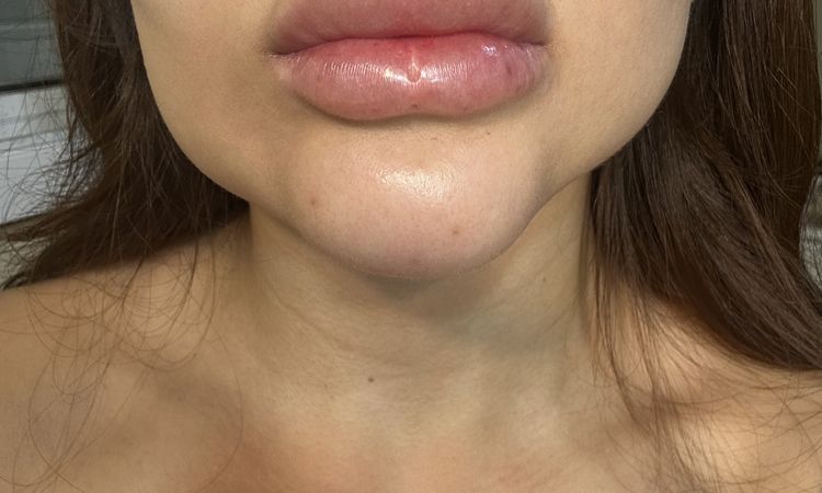 Endopeel en el rostro por primera vez, no iba a inflamarse mucho - 60168