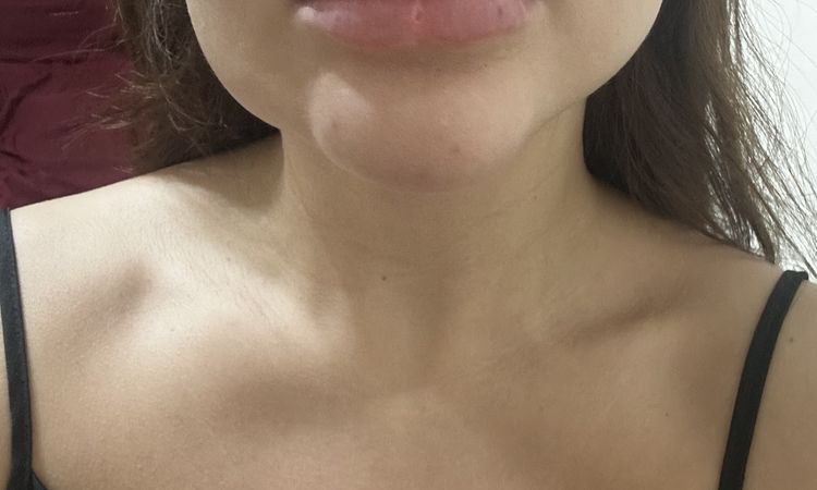 Endopeel en el rostro por primera vez, no iba a inflamarse mucho - 60169