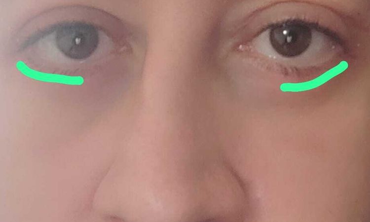 blefaroplastia ectropion? - 60191