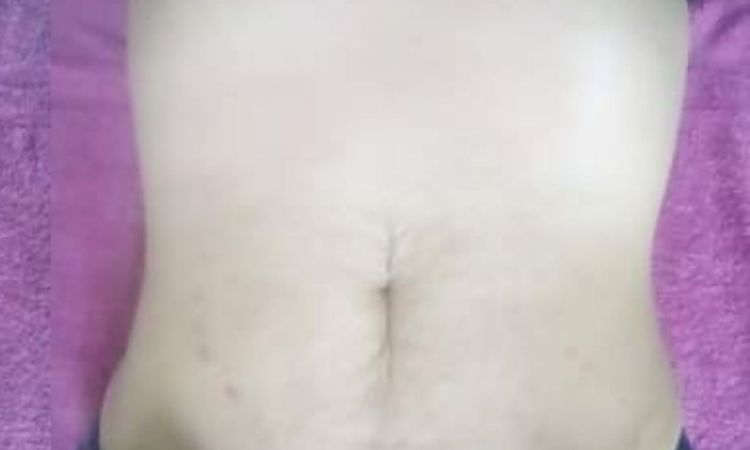 Me hice Dermapen para las estrías - 60481
