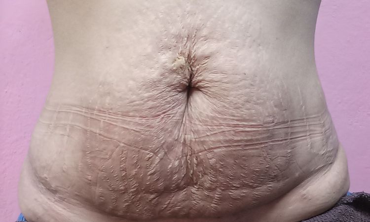 Me hice Dermapen para las estrías - 60482