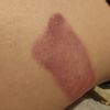 Hematomas desdes de criolipolisis
