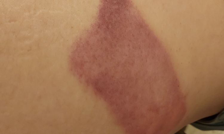 Hematomas desdes de criolipolisis - 60540