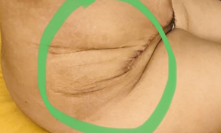 Sospecha de mala abdominoplastia - 60886