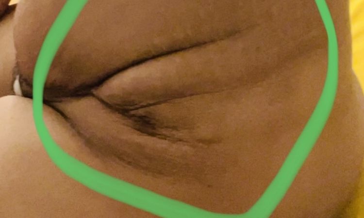 Sospecha de mala abdominoplastia - 60887