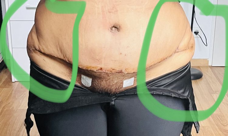 Sospecha de mala abdominoplastia - 60888