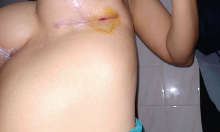 Cicatriz abierta tras dos meses - 60929