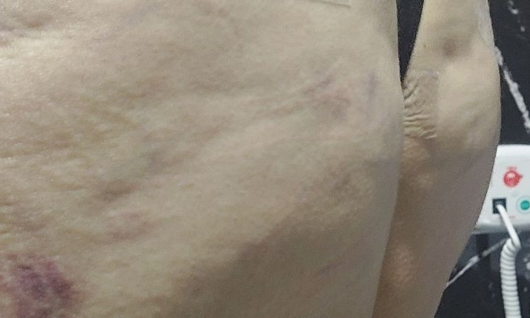Abdominoplastia y tranferencia de glutios - 60930