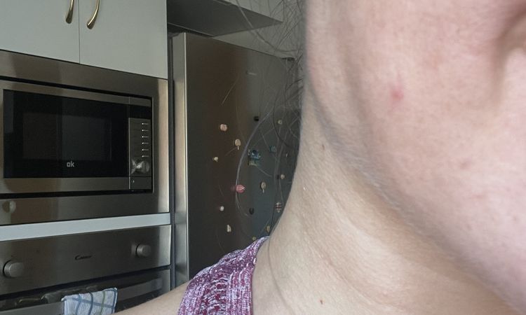 Lipolaser facial funcionara? - 61079