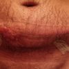 Quemadura tras endolifting Lipolaser