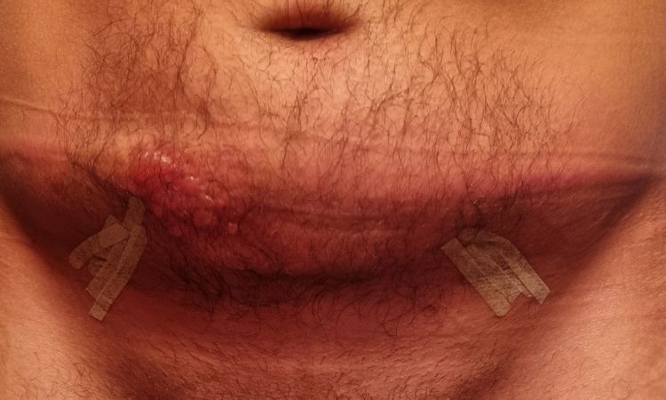Quemadura tras endolifting Lipolaser - 61125