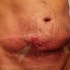 Quemadura tras endolifting Lipolaser