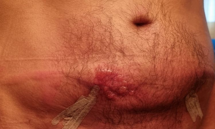 Quemadura tras endolifting Lipolaser - 61126