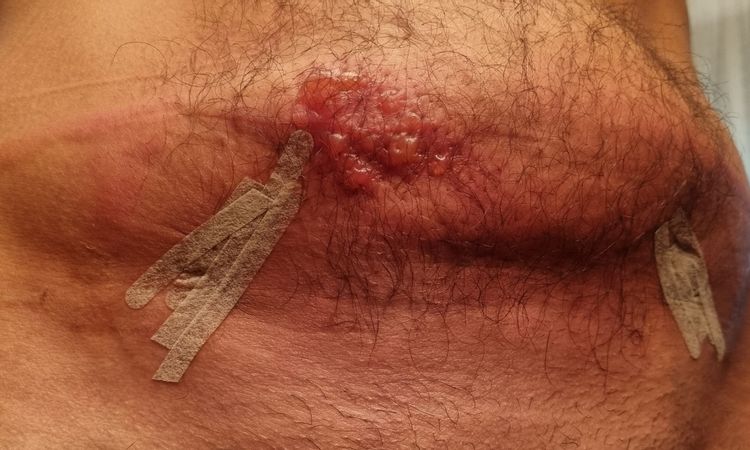 Quemadura tras endolifting Lipolaser - 61127