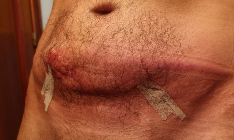 Quemadura tras endolifting Lipolaser - 61128