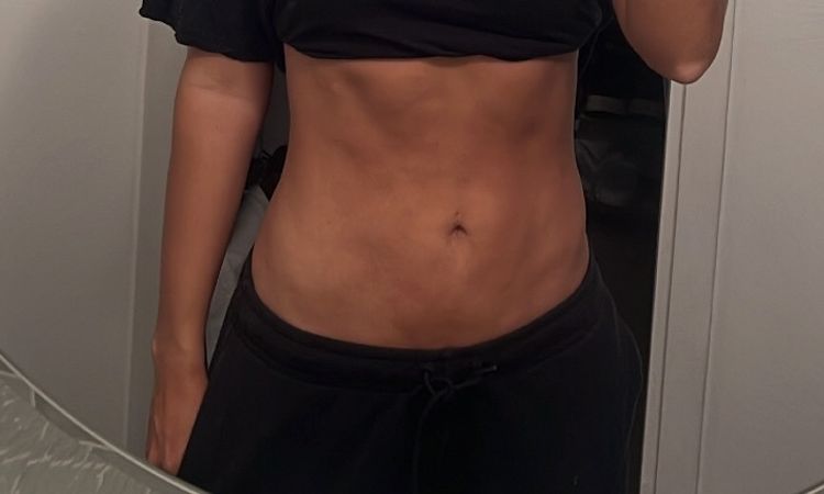 Tras 2 años de liposucción: cómo mejorar el aspecto del abdomen? - 61212