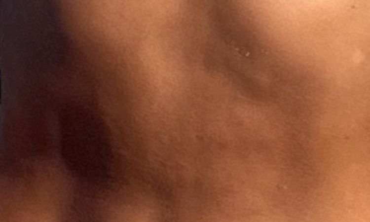 Tras 2 años de liposucción: cómo mejorar el aspecto del abdomen? - 61215