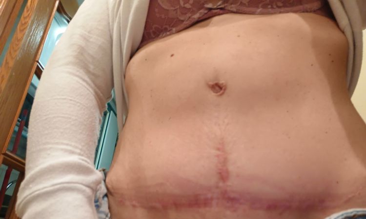 Abultamiento en zona de ombligo después de 10 meses de abdominoplastia - 61465