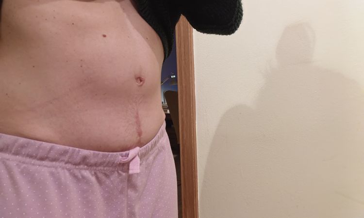 Abultamiento en zona de ombligo después de 10 meses de abdominoplastia - 61466