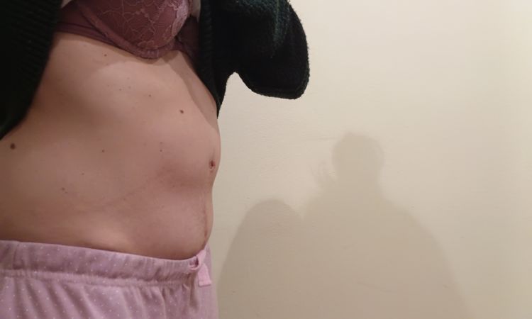 Abultamiento en zona de ombligo después de 10 meses de abdominoplastia - 61467