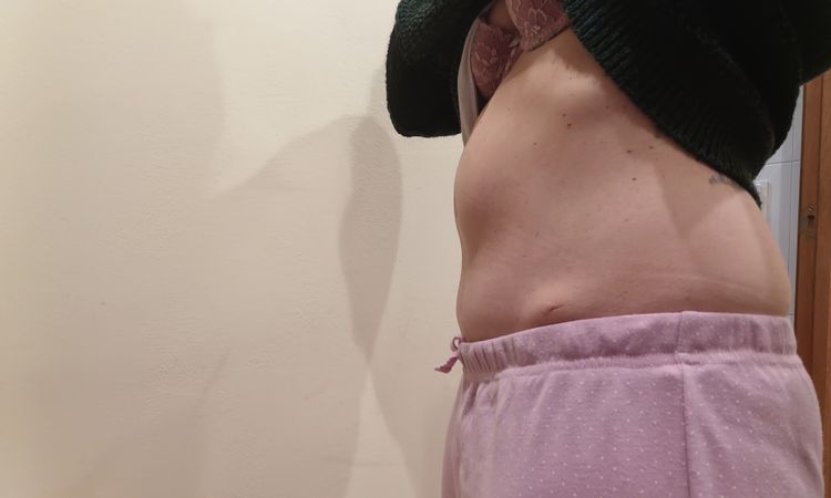 Abultamiento en zona de ombligo después de 10 meses de abdominoplastia - 61468