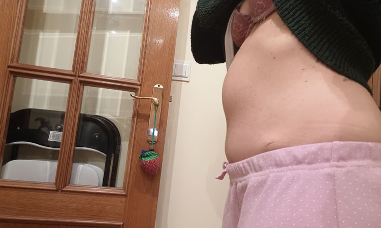 Abultamiento en zona de ombligo después de 10 meses de abdominoplastia - 61469