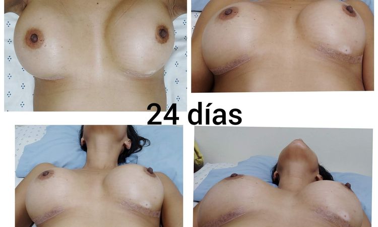 Asimetria de torax o implante desplazado? - 61506