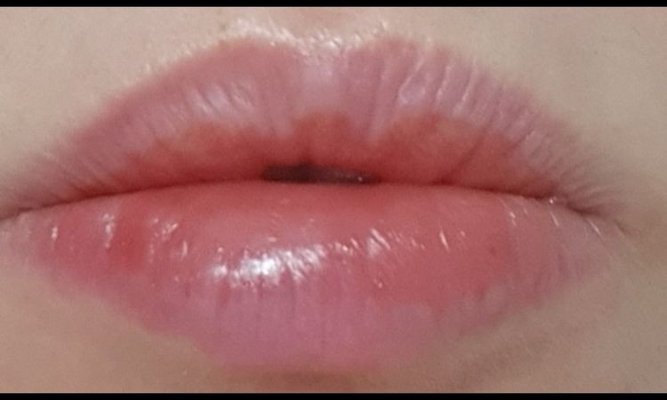 Relleno de labios irritación y picor - 62032