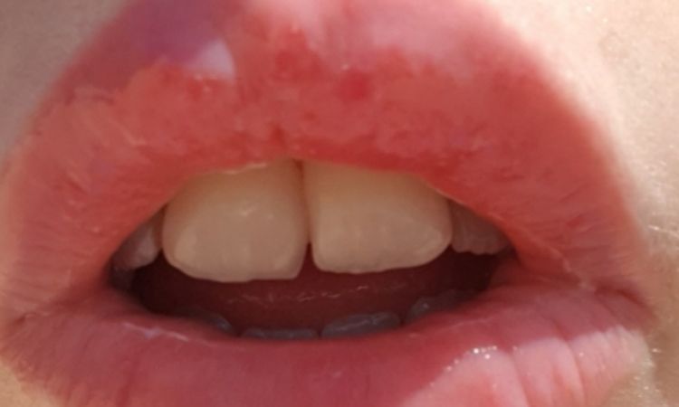 Relleno de labios irritación y picor - 62033