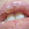 Relleno de labios irritación y picor - 62034