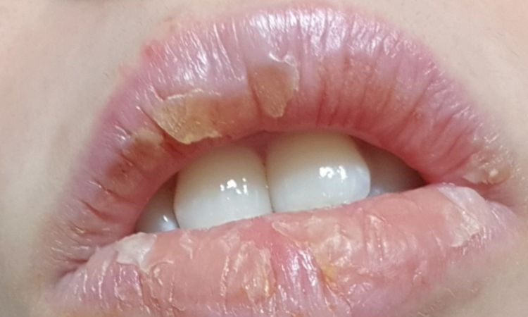 Relleno de labios irritación y picor - 62034