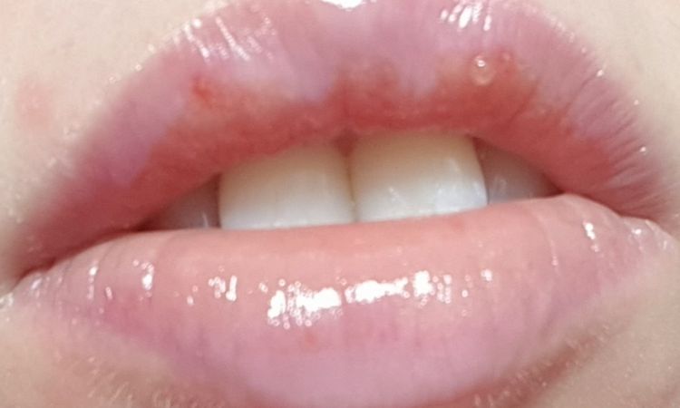 Relleno de labios irritación y picor - 62035