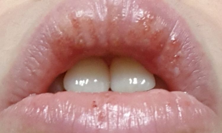 Relleno de labios irritación y picor - 62036