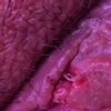 Uso de fitoestimulin para que la zona cicatrice por 2da intencion