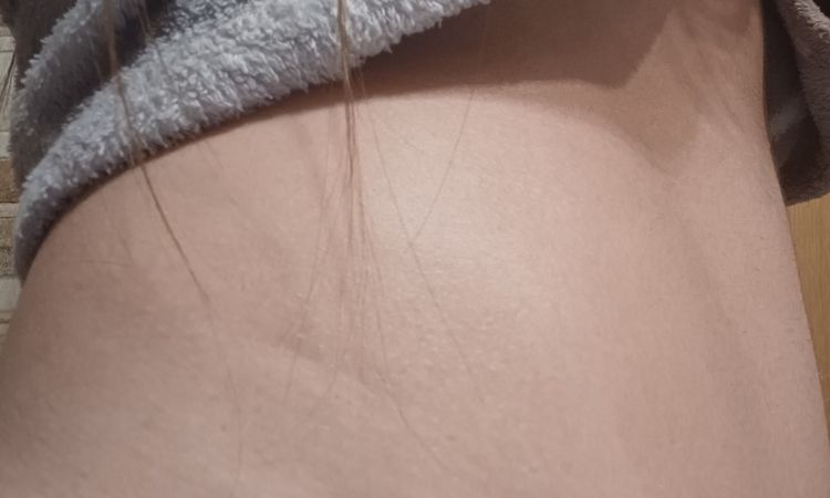 Abdominoplastia despues de 2 años - 62136