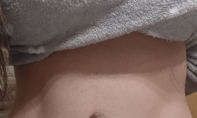 Abdominoplastia despues de 2 años - 62137