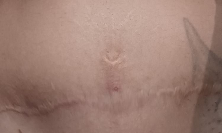 Abdominoplastia despues de 2 años - 62138