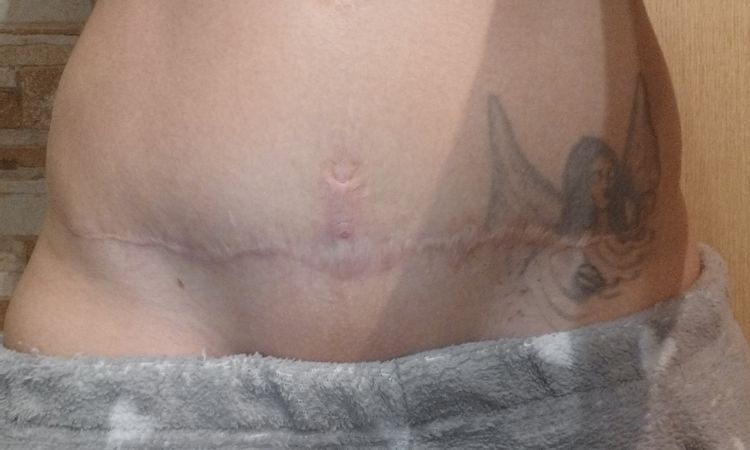 Abdominoplastia despues de 2 años - 62139