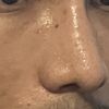 Hundimiento al lado derecho de la nariz después de rinoplastia