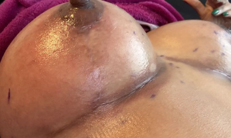 Cicatriz del borde de la prótesis negra y roja - 62344