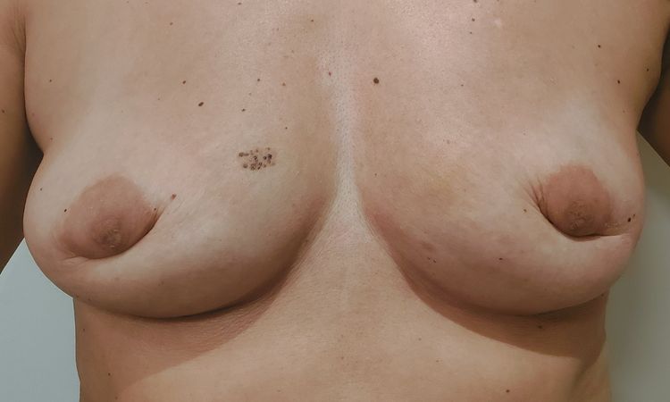 Areolas hundidas por antigua cicatriz - 62920