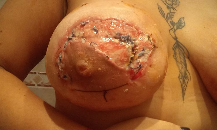 Mastopexia mala cicatrización por puntos del pezón - 63232