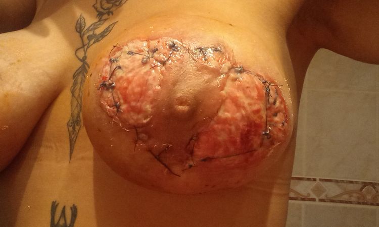 Mastopexia mala cicatrización por puntos del pezón - 63234