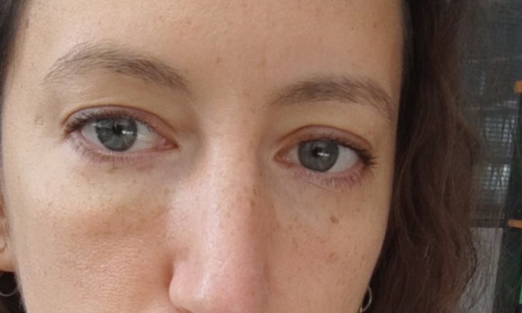 Efecto Tyndal en ojeras? - 63676