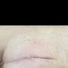 ¿Cómo eliminar un pliegue de una cicatriz de reconstrucción mamaria?
