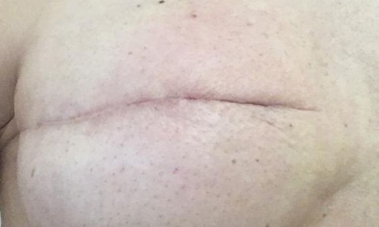 ¿Cómo eliminar un pliegue de una cicatriz de reconstrucción mamaria? - 63987